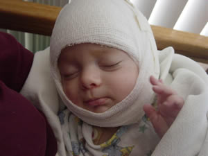 After scaphocephaly surgery, front bandaged view