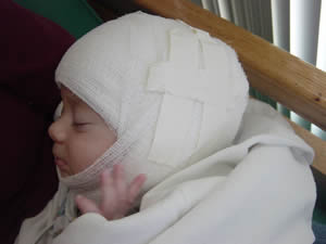 After craniosynostosis surgery, side bandaged view