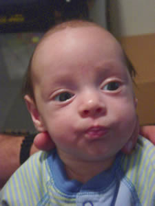 Front view of child with scaphocephaly/craniosynostosis