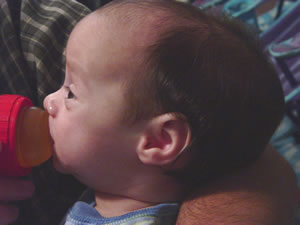 Side view of scaphocephaly