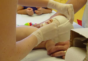 head casting - bandages going on