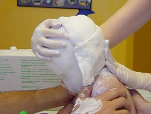 head casting - last bandage being put on